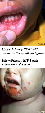 Primary HSV - Example